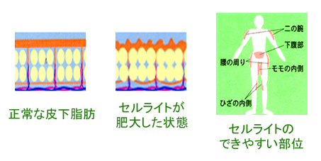 セルライト